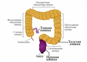 Колостома